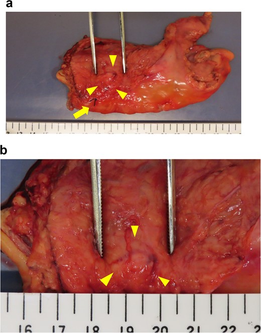 Intraoperative evaluation of the resected specimen. The specimen was removed by tumor-specific mesorectal excision. The arrowheads indicate the area containing the nodule. The arrow indicates the marking stitch placed at the distal edge of the nodule. (a) View of the specimen. (b) Enlarged view of the nodule.