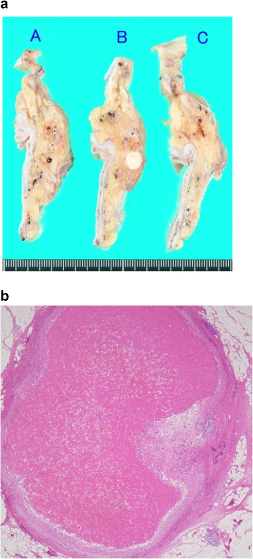 Pathological findings of the resected specimen. (a) Macroscopic finding. A solid white nodule with a diameter of 7 mm is embedded in the mesorectum. (b) Microscopic findings observed with hematoxylin–eosin staining. The nodule comprises an intravenous organized thrombus with surrounding granulation tissue. No malignancy is observed.