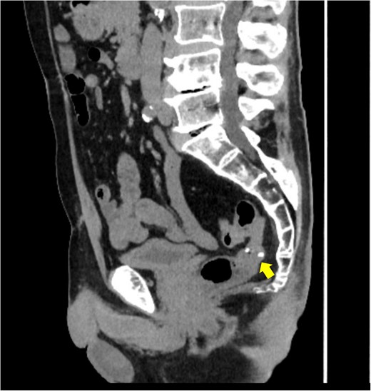 Surveillance computed tomography (CT) image of the pelvis at 16 months postoperatively. No lesions were observed in the mesorectum. The arrow indicates the staples used at the colorectal anastomosis.
