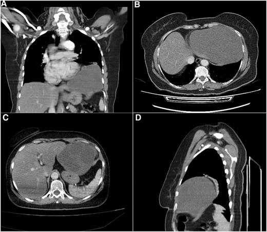 Computed tomography (CT) scan. (A) Coronal section, shows the cystic formation in the left hemi-thorax. (B) and (C) Axial section, shows the borders with the pericardium and the left hepatic lobe. (D) Sagittal section, shows the limited posterior extension of the cyst.