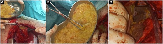 Intraoperative image (A) shows the cyst wall after it was opened and the daughter cysts were being evacuated. (B) A huge number of necrotized daughter cysts. (C) The cyst cavity after it was evacuated.