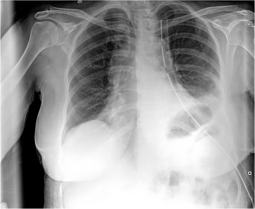 Postoperative CXR. It shows partial lung expansion with apical chest tube.