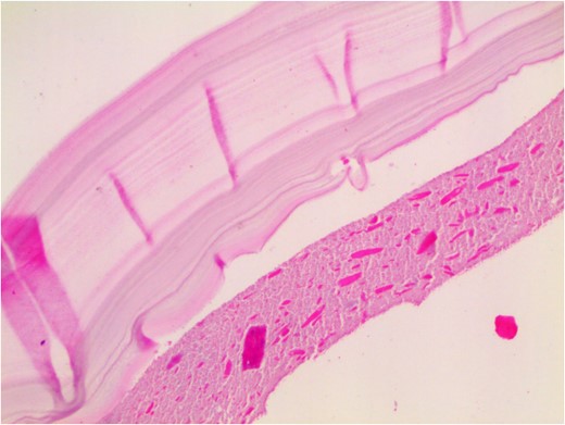 Histopathological examination: the cyst wall comprises an acellular laminated membrane and an inner nucleated germinal layer. Within the cystic cavity, necrotic debris is predominantly present. (Hematoxylin and eosin staining; 100× magnification.)