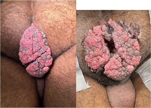 Posterior view of the anogenital region with an exophytic vegetative lesion measuring ~9 × 7 cm.