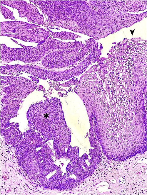 Hematoxylin and eosin staining of an anorectal GCA, also known as BLT; a hyperplastic papillary exophytic squamous epithelium is appreciated, with prominent fibrovascular cores and koilocytosis (➤) that is confined to the upper third of squamous epithelium on the left.