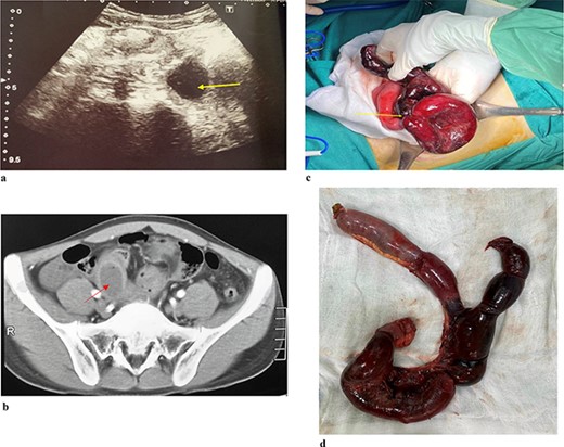 (a). Ultrasound shows an arrow pointing to anechoic structure with hypoechoic wall. (b) Axial CT scan showing an arrow pointing to an ileal cyst dilation with bowel ischaemia. (c) Intraoperative image of small bowel ischaemia with an arrow pointing to the strangulated location. (d) Postoperative image shows ileal duplication cyst.