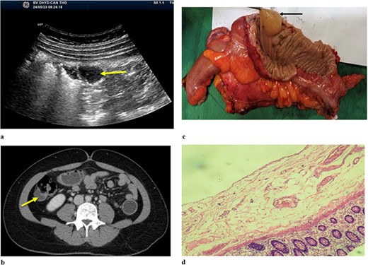 (a) Abdominal ulstrasound shows an arrow pointing to anechoic structure with septation. (b) Axial CT scan showing an arrow pointing to a cystic structure protruding into the lumen of ascending colon. (c) Arrow pointing to colonic duplication cyst. (d) Microscopic examination, the inner lining of the cyst consisted of flat epithelium containing mucin.