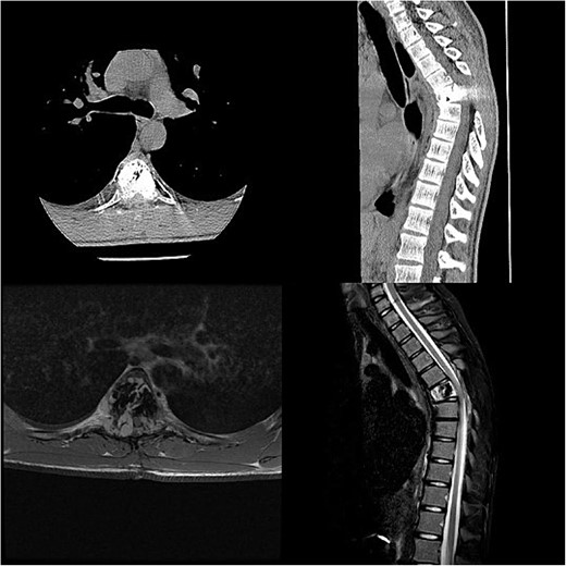 Follow-up CT imaging revealed recurrent AVH of the Th6 vertebrae, MRI scan showing AVH expanding into the spinal canal and causing myelopathy.