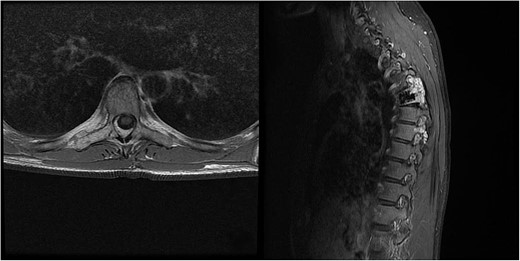 MRI scan of the thoracic spine showing a concomitant haemangioma in the right transverse and articular process of Th8.