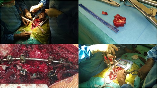 Intraoperative pictures of Th6 removal, instrumentation, and cage application.