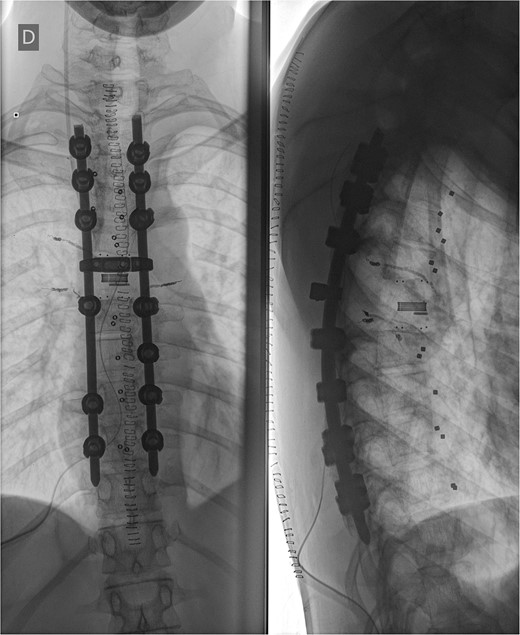 Postoperative X-ray imaging immediately after surgery; anteroposterior view (left) and lateral view (right).