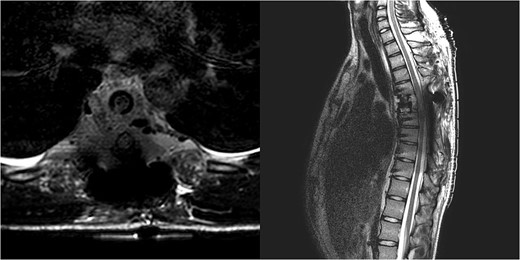 Immediate postoperative MRI showing no residual signs of thoracic spinal cord compression.