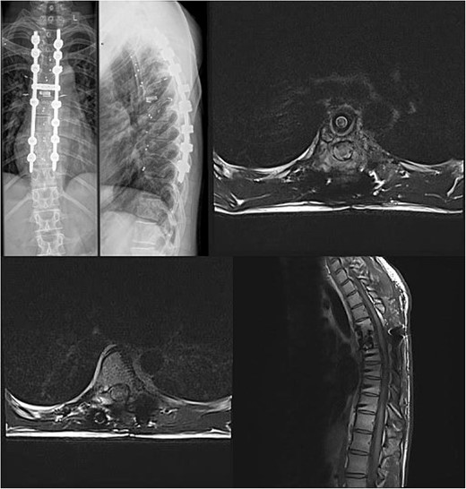 Final follow-up X-Ray scan and MRI imaging showing no radiological signs of spinal instability or myelopathy.
