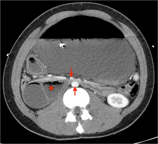 Axial CT showing severely distended stomach and dilated duodenum with transition point between SMA and aorta. (★: Duodenum. ↓: Superior mesenteric artery. ↑: abdominal aorta).
