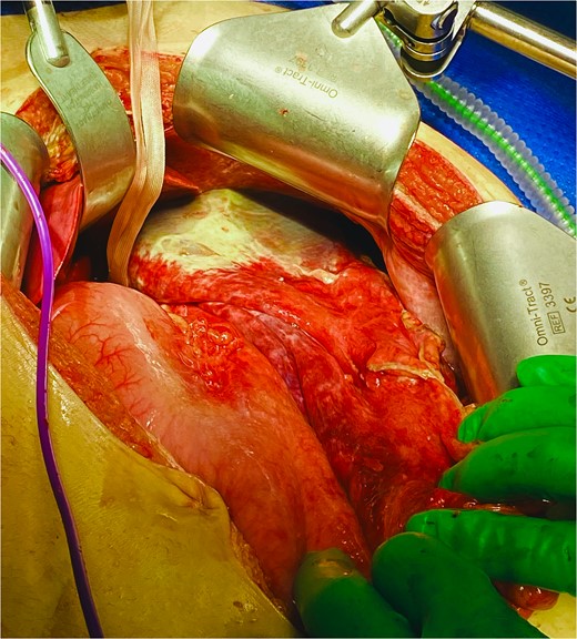 Total gastrectomy specimen showing areas of gangrene and necrosis.
