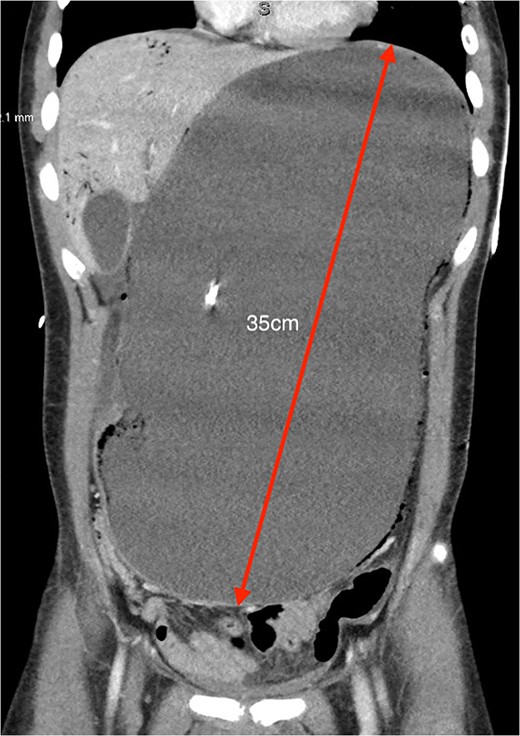 Coronal CT showing severely distended stomach to the pelvis (35 cm in greatest length) with evidence of pneumotosis and portal venous gas.