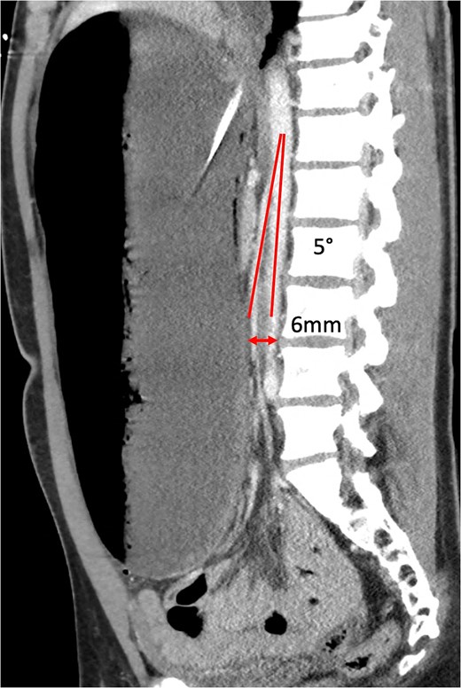 Sagittal CT showing aortomesenteric angle (5°) and aortomesenteric distance (6 mm).