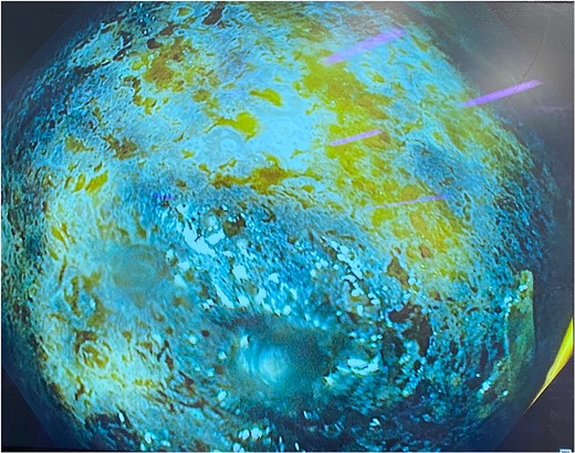 Gastroscopy showing multiple areas of mucosal ulceration and ischaemia.