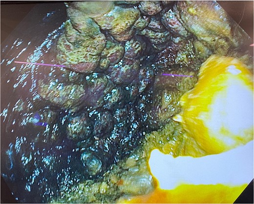 Gastroscopy showing multiple areas of mucosal ulceration and ischaemia.