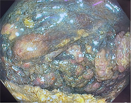 Gastroscopy showing multiple areas of mucosal ulceration and ischaemia.