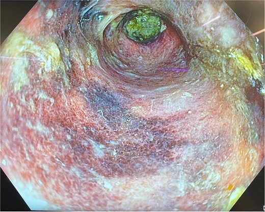 Gastroscopy showing multiple areas of mucosal ulceration and ischaemia.