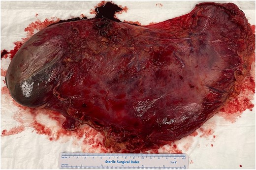 Total gastrectomy specimen showing areas of gangrene and necrosis.
