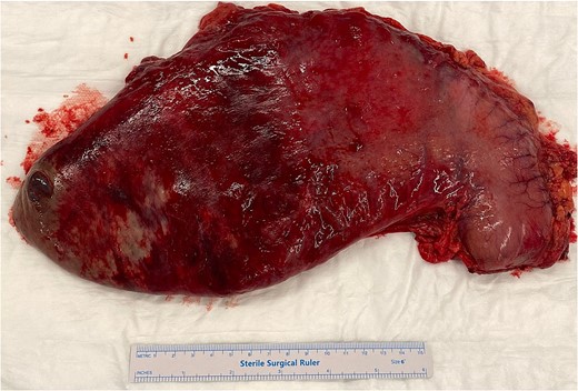 Total gastrectomy specimen showing areas of gangrene and necrosis.