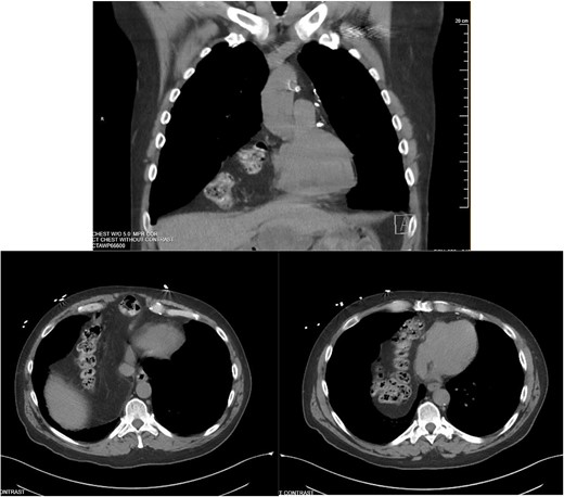 Screening chest CT scan.