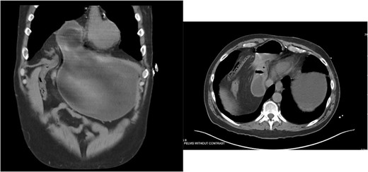 Right-sided type 4 anterior diaphragmatic hernia with antrum and pylorus herniation.