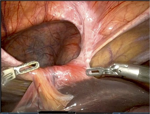 Reduced hernia.
