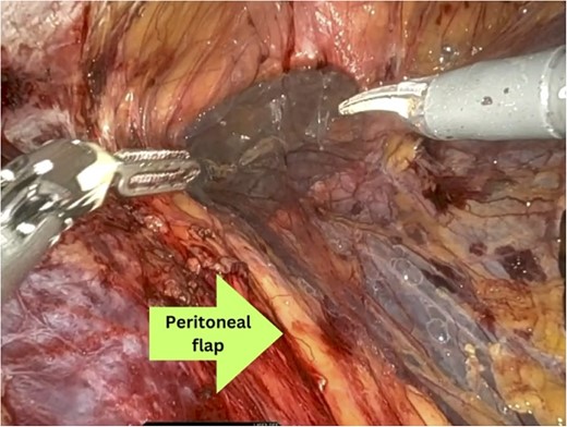 Preperitoneal dissection.