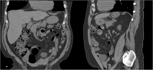 Ten months post-operative CT scan.