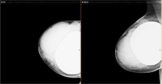 CC and MLO of right breast mammogram.