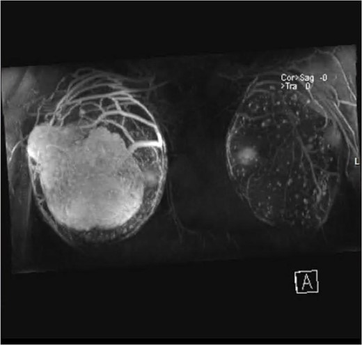 MRI with contrast of right breast and left breast.