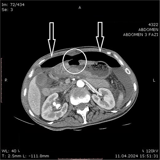 Abdominal computer tomography (axial scan) with pneumoperitoneum (arrows) and visible discontinuity of the anterior stomach wall suggestive of ulcer perforation (encircled).