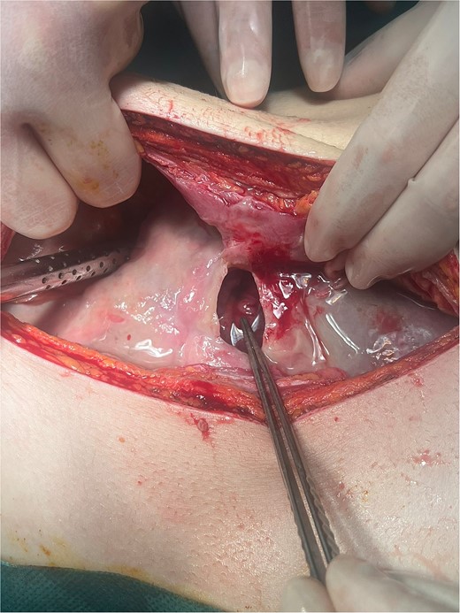 Giant ulcer of the anterior wall of the stomach adhered to the round ligament (intraoperative finding during laparotomy).