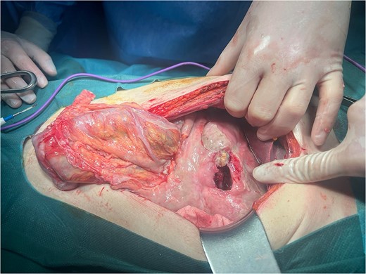 Ulcer detached from the anterior abdominal wall.