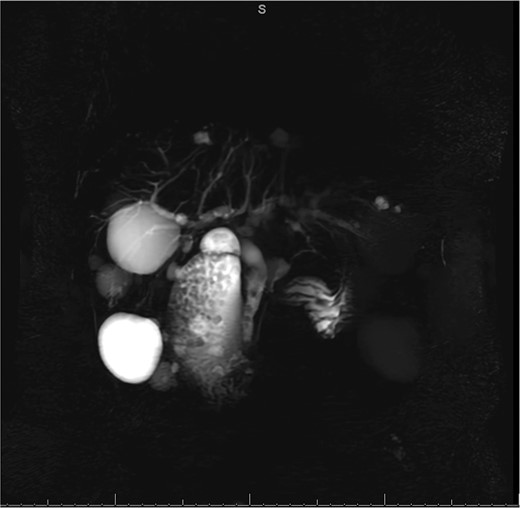 MRCP from initial hospitalization, including cysts in the area of the gallbladder fossa, cholelithiasis, choledocholithiasis and CBD dilation, measured to be 1.5 cm (measurement not included in image).