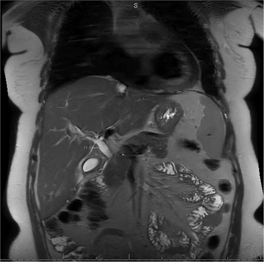 MRI/MRCP from second hospitalization demonstrating CBD of 1.1 cm.