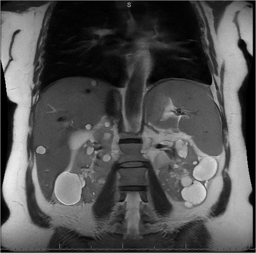 MRI/MRCP from second hospitalization demonstrating liver and kidney cysts.