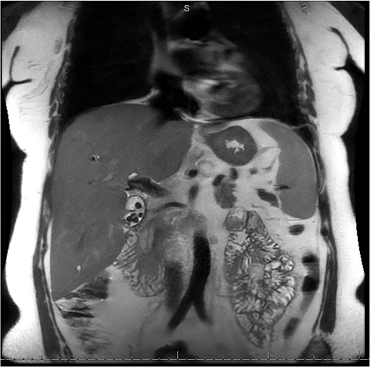 MRI/MRCP from second hospitalization demonstrating recurrent cholelithiasis.