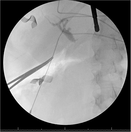 Intraoperative cholangiogram from second procedure demonstrating trifurcation of the right posterior, right anterior and left hepatic ducts, as well as a dilated cystic duct.