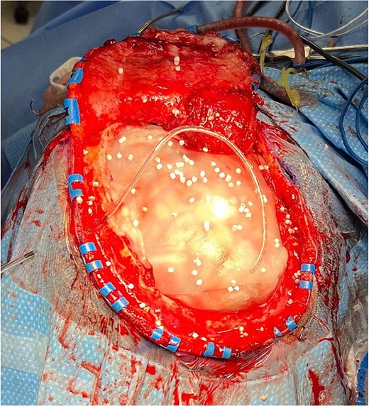 Antibiotic-impregnated dissolvable synthetic calcium sulfate beads (Stimulan Rapid Cure) in a patient undergoing cranioplasty.