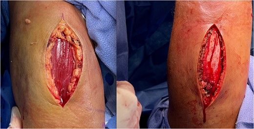 Right upper extremity anterior compartment fasciotomy (left) and posterior compartment fasciotomy (right), with muscles exposed following release of fascia.