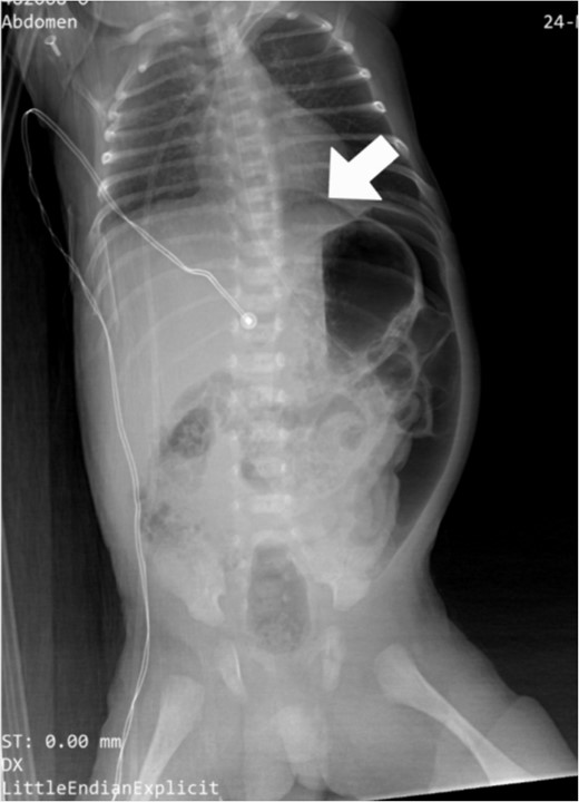 Preoperative abdominal X-ray: lateral decubitus view showing pneumoperitoneum (white arrows).