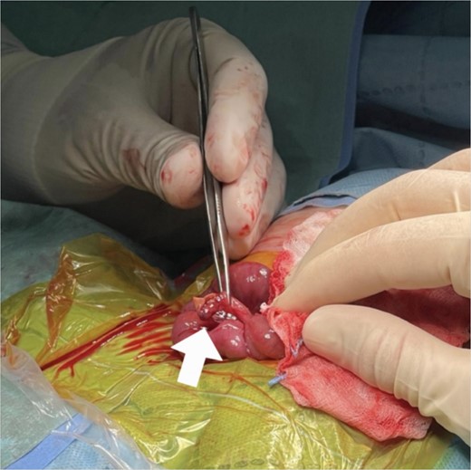 Intraoperative findings: inflamed appendix with perforation on the tip (arrow).