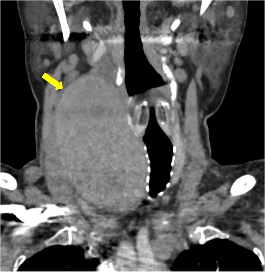 Coronal imaging of the unenhanced CT shows a large right thyroid lobe heterogeneous mass measuring 9.2 cm × 5.2 cm × 5.5 cm with mass effect on the airway and tracheal displacement to the left.