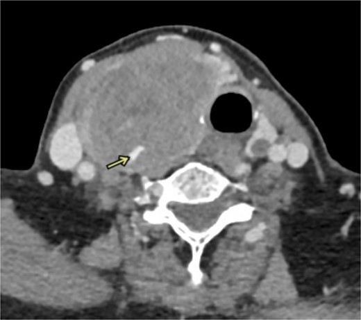 CT angiography shows active extravasations along the posterior aspect of the right thyroid lobe mass.