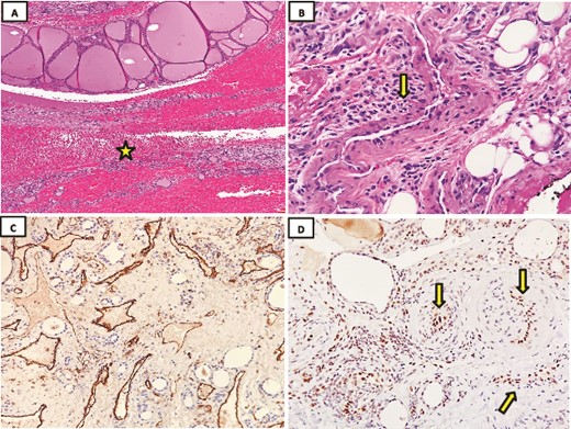 Histopathology examination was done using hematoxylin and eosin stain (H&E). (A) Microscopic evaluation of the lesion consisted of a rim of thyroid tissue filled with a central hemorrhagic zone (star) (H&E; 4x). (B) The lesion comprises a compact growth of thick wall blood vessels lined by plump endothelial cells (arrow) (H&E; 10x). (C) Immunohistochemical staining showed strongly positive CD31 in endothelial cells (40x). (D) Strongly nuclear positive endothelial cells for FLI1 (arrow) (40x).
