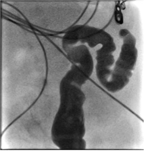 Contrast enema showing failure of passage of contrast beyond descending colon.